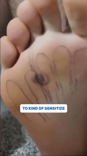 Morton’s Neuroma Relief: Can Massage Really Help?