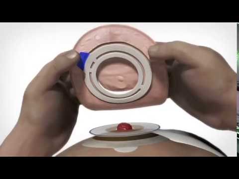 Applying a 2-piece SenSura Flex closed ostomy pouch