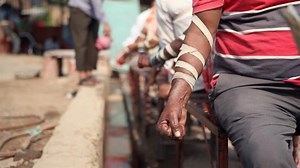 Bloodletting Is Still Happening, Despite Centuries of Harm