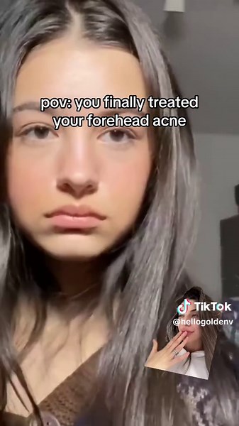 Best Routine for Clogged Pores on Forehead - Effective Tips