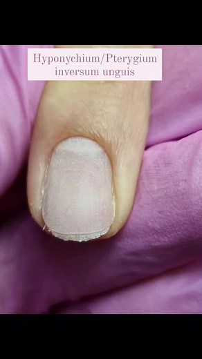 👇Hyponychium/Pterygium Inversum Unguis •it is very strong vascularized and painful tissue •it is difficult for nail technicians to do nail extensions because they will need to file the nail and free the hyponychium so they can fit the nail form on top of it. The nail form needs to be situated always on top of the hyponychium. ●Causes: - wearing long nails for longer period of times - biting nails - contact dermatitis - can be born with it - injury or trauma to the nail ●To help it at home: - ap
