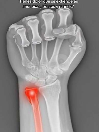 Muñequera de Electroterapia #muñequera #electroterapia #tunelcarpiano #rehabilitación #wristpain Alivia el dolor de muñeca y túnel carpiano con impulsos eléctricos suaves que estimulan los nervios y mejoran la circulación. Ideal para usar en casa, en el trabajo o mientras descansas. Alivio sin medicamentos, cómodo y efectivo.