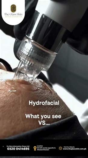 What you see is a vacuum tip gliding over the skin — but what’s happening goes far beyond surface-level cleansing. As the HydraFacial handpiece moves across the face, multiple processes work simultaneously. The skin is gently exfoliated, removing dead skin cells that clog pores and dull the complexion. At the same time, impurities and congestion are loosened and extracted using controlled vacuum technology — all without causing trauma to the skin. But it doesn’t stop there. While the pores are b