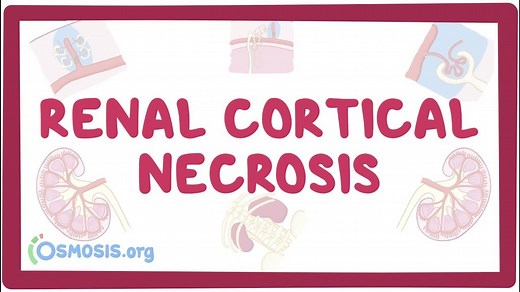 Renal cortical necrosis: Video, Causes, & Meaning | Osmosis