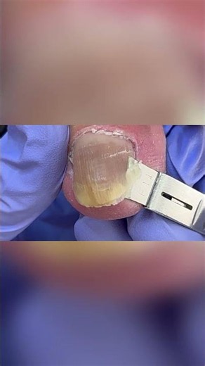 How to fix an ingrown toenail at home #pedicure #toenails #satisfying #nails