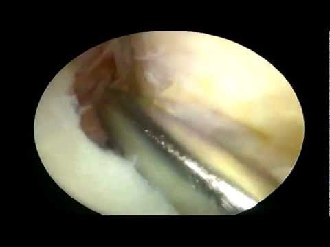 Pigmented Villonodular Synovitis (PVNS)