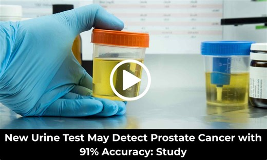 New Urine Test May Detect Prostate Cancer with 91 Percent Accuracy: Study