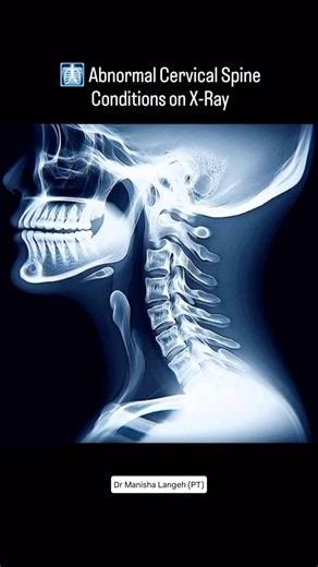 Abnormal Cervical Spine X-Ray Findings Explained | Common Cervical Spine Conditions #physiotherapy