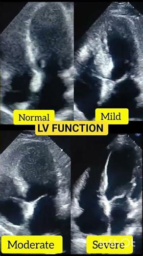 LV FUNCTION IN 2D #medical #echocardiography #health #heart #viral