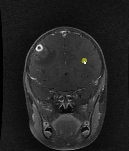 Tuberculomas with TB meningitis
