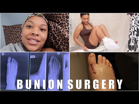 BUNION SURGERY VLOG #1 | Pain After Surgery, Cast Removal & Showering