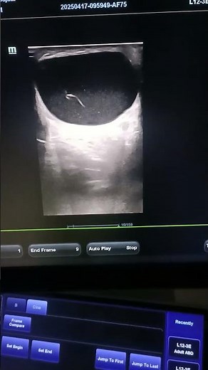 Epididymal cyst scrotal cyst