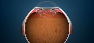 Iridex PSLT™ (Pattern Scanning Laser Trabeculoplasty) treatment for IOP Reduction - Eyetube