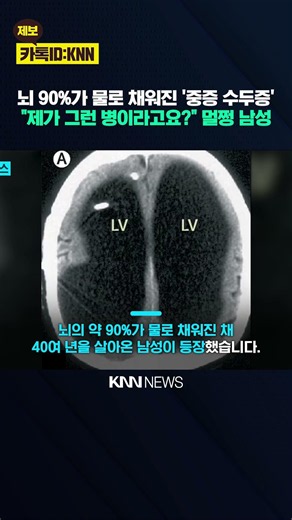 Living Just Fine with 90% of His Brain Gone for '40 Years'? A Real-Life Case That Shocked the Med...