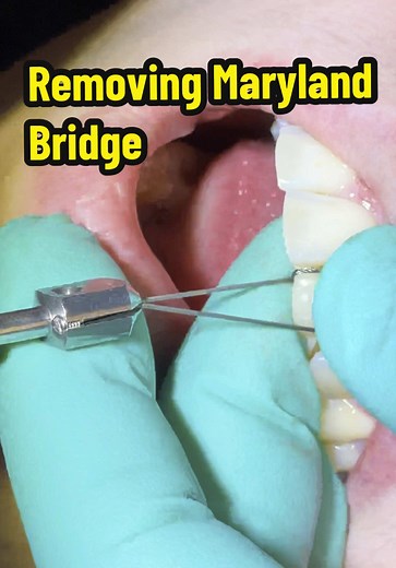 Removing a Maryland bridge with Anthogyr Safe Relax Crown & Bridge Rem...