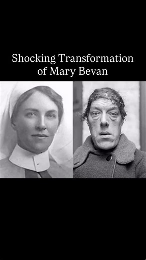 History Everyday on Instagram: "Mary Ann Bevan (1874 - 1933) was an English woman who toured the sideshow circuit as “the ugliest woman in the world” after her appearance drastically changed due to developing acromegaly. It leads to excess growth hormone which causes enlargement of the forehead, jaw, and nose. In the early 2000s, Bevan’s image was used by Hallmark Cards on a birthday card in the United Kingdom. The card made reference to the television dating show Blind Date. Subsequently, a com