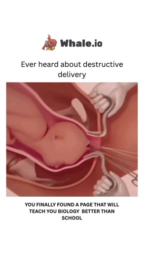 BIOLOGY | MEDICAL | HEALTH on Instagram: "“Destructive delivery” refers to a group of surgical obstetric procedures known as destructive operations or embryotomy, which involve diminishing the size of a dead or abnormally deformed fetus to allow for vaginal delivery. These operations, such as craniotomy (reducing fetal head size), decapitation (severing the head), or cleidotomy (cutting the clavicles), are rarely used in modern, high-resource settings due to the prevalence of safe Caesarean sect
