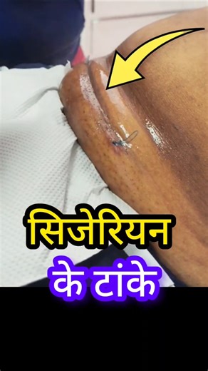 Cesarean delivery stitches