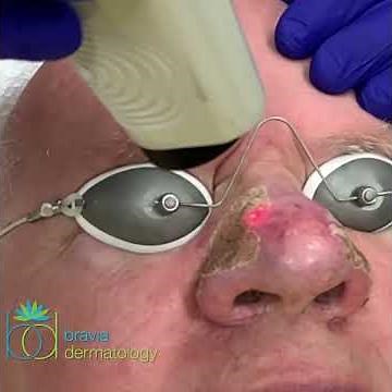 CO2 blending of rhinophyma - Bravia Dermatology in Toledo, OH