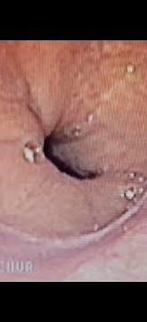 Schatzki's Ring.... thanks to Dr Vithal Udagatti From Raichur for the material.