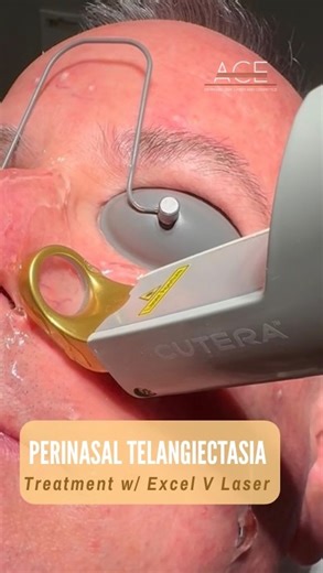 Watch those veins disappear!!! Love, love, love the Excel V laser for these large telangiectasia, it produces amazing results that are truly gratifying for the patient. If you are suffering with facial veins or redness, call us today to schedule your consultation for this fabulous laser treatment. To see Dr. Shalini Bahl please contact ACE Dermatology ☎️ (937) 885-4412 💻https://www.acederm.com 📧 Info@Acederm.com #dermatology #facialveinremoval #excelvlaser #rosea #healthyskin | Ace Dermatology