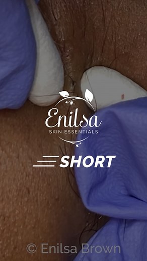 Enilsa Brown on Instagram: "Hello sweet friends! This is a short of Emily's second treatment. In the full video on my Youtube channel, I give her light dermaplaning followed by 15 minutes of extractions. Head to Youtube for the whole show!  #acne #blackheads #extractions #pimplepopping"
