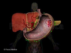Stage 4 - Gastric Cancer - Animated Atlas of Breast and Gastric Cancer