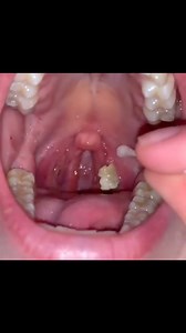 Self extraction of a large tonsil stone! Tonsil stones or tonsilloliths, are hard white or yellow formations that are located on or within the tonsils. They are primarily composed of debris, bacteria, mucus, and food particles that accumulate and become stuck in the nooks and crannies of the tonsils that before getting calcified over time. It’s common for people with tonsil stones to not even realize they have them. Tonsil stones aren’t always easy to see and they can range from rice-sized to th