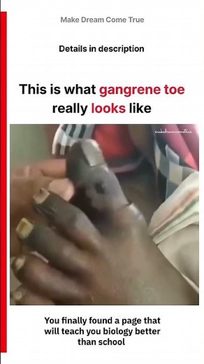 🦶This is what gangrene toe ⚠️ really looks like | MDCT