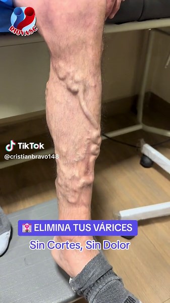 🏩 ELIMINA TUS VÁRICES ☺️🤝 Escleroterapia con espuma de POLIDOCANOL 😎 Sin Cortes , Sin Dolor , Sin Hospitalización 🫡 Riovasc - RIOBAMBA 📲 593995178395 #cristianbravo148 #varices #varicesyarañitas #varicesenlaspiernas #varicesgrandes #piernaslindas #belleza #cirugiavascular #viral #ecuador