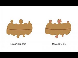Evaluating acute diverticulitis