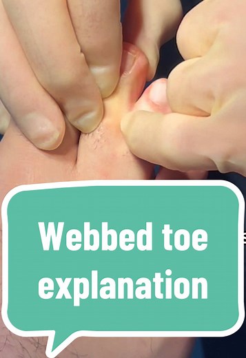 Webbed toe explanation #webbedtoes #desyndactyly #podiatry #fyp