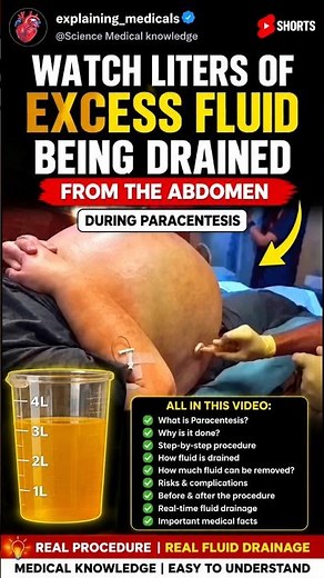 🩺 Watch Liters of Excess Fluid Being Drained From the Abdomen During Paracentesis!