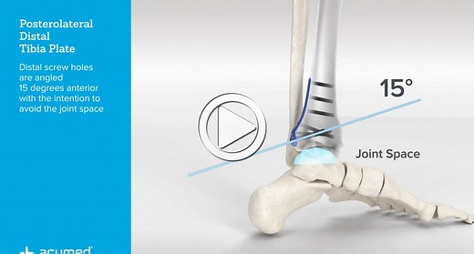 Ankle Plating System 3 Overview