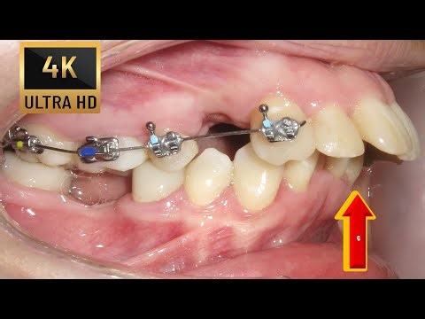OVERJET in Adults ❗ Braces in 4 k resolution!