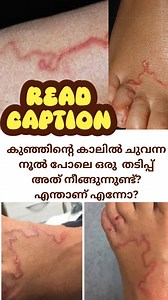 Cutaneous larva migrans (CLM)- മൃഗങ്ങളിൽ കാണപ്പെടുന്ന കൊളുത്തുപുഴുക്കളുടെ (Hookworm) ലാർവകൾ ചർമ്മത്തിലൂടെ തുളച്ചുകയറി സഞ്ചരിക്കുന്നത് മൂലമുണ്ടാകുന്ന ഒരു ചർമ്മരോഗമാണിത്.മനുഷ്യർ ഈ പുഴുക്കളുടെ സ്വാഭാവിക ആതിഥേയരല്ല. അതിനാൽ മനുഷ്യശരീരത്തിൽ ഇവയ്ക്ക് കൂടുതൽ വളരാൻ സാധിക്കില്ല (Dead-end hosts).Ancylostoma brasiliense എന്ന ജീവിയാണ് പ്രധാനമായും ഇത് പടർത്തുന്നത്. കൂടാതെ A. caninum, A. ceylonicum, Uncinaria stenocephala എന്നിവയും കാരണമാകാം.നായയുടെയോ പൂച്ചയുടെയോ മലം കലർന്ന മണ്ണിലോ മണലിലോ നഗ്നപാദരായി നടക്കുമ്പ