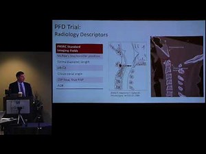 Update Posterior Fossa Decompression With or Without Duraplasty Trial David D Limbrick, MD, PhD