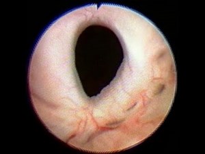 How To Deal With Bladder Neck Contracture: Tips For Urology Residents