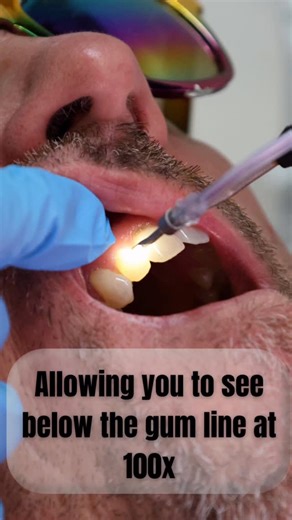 Perio View on Instagram: "See what sets PerioView apart. Our advanced sub gingival imaging fiber brings unmatched clarity and precision to every Perio procedure, transforming the way clinicians visualize, diagnose, and treat. Request a demo at www.perio-view.com thank you to @peachstaterdh for sharing your videos with us. #perioview #periodontalhealth #periodontalendoscopictherapy #rdh #periodontaldisease #perioviewbeliever #dentalendoscopy #dentalendoscope #happygums #dentalhygiene #hygienist #