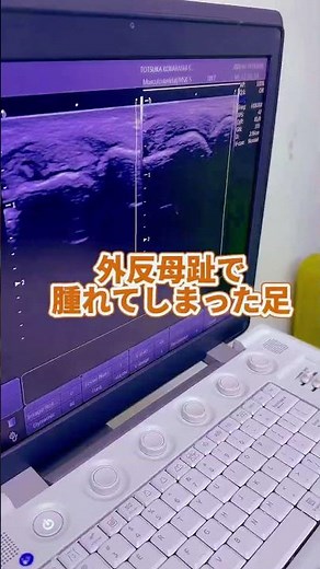 外反母趾で足が腫れる本当の理由。エコーで見る痛みの原因が意外すぎる！ #戸塚小林整骨院 ＃外反母趾＃足の痛み＃戸塚整体＃内反小趾