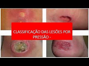 Classification of Pressure Injuries According to the Brazilian Society of Stomatherapy
