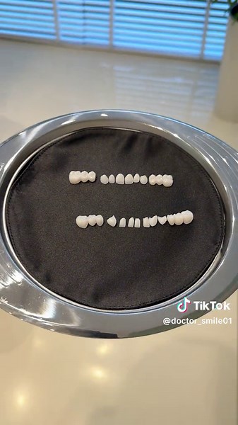 Hollywood Smile Transformation for a Lucky Patient