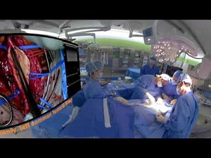 Endardaterectomy of common femoral artery