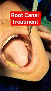 Root Canal Treatment #rct #Protaper #GP #Gutta Percha #Obturation