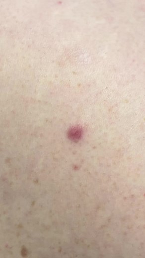 What is Dermatofibroma? Understanding Skin Nodules