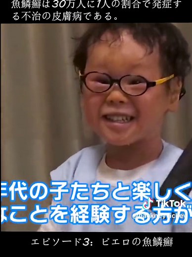 魚鱗癬についてのドキュメンタリーエピソード3