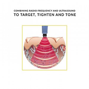 EXILIS ULTRA 360 machine will help contour your body, smoothen your...