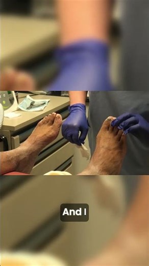 Why This Nail Problem Keeps Coming Back | Understanding Fungal Nail Infections 🦶