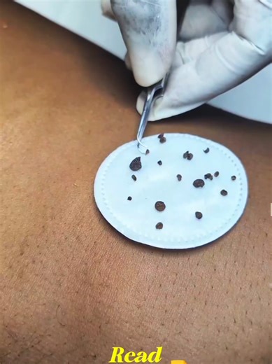🎓 HOW TO PREVENT SKIN TAGS (Simple & Effective Tips) Skin tags don’t appear overnight — they often develop due to friction, hormonal changes, weight gain, insulin resistance, and poor skin care habits. The good news? Many skin tags are preventable when you take the right steps early. Here’s how to reduce your risk of developing skin tags: ✅ Reduce skin friction Avoid tight clothing around the neck, underarms, breasts, groin, and inner thighs. Constant rubbing encourages skin tag formation. ✅ Ma