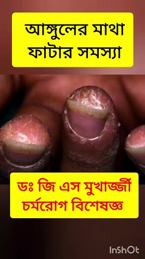 64K views · 150 reactions | Finger tip eczema #eczema #eczemarelief #eczemacare #dryness #eczematreatment #eczemaproblems Dr. G S Mukherjee - Dermatologist, cosmetologist and sexologist | Dr. G S Mukherjee - Dermatologist, cosmetologist and sexologist | Facebook